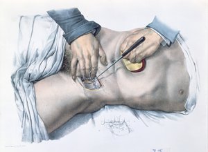 Atando una arteria, placa de 