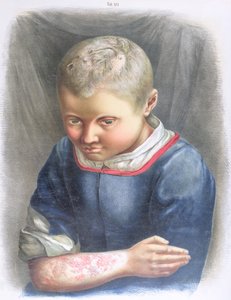 Favus, de un libro de Daniel Cornelius Danielssen, 1892 de Norwegian School