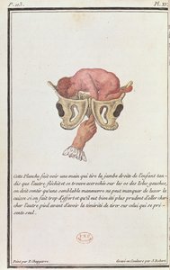 Diagrama transversal de un bebé sacado del útero por el brazo, de un libro de Madame Angélique Le Boursier du Coudray grabado por J. Robert, 1783