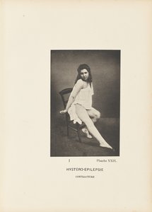 Contractura histeroepiléptica