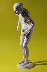 Figura de una mujer con enfermedad de Parkinson de Paul Marie Louis Pierre Richer