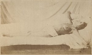 Epilepsia histérica, ataque, crucifixión, lámina VI de 