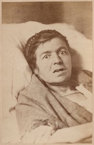 Epilepsia histérica, contracción facial, lámina VIII de 