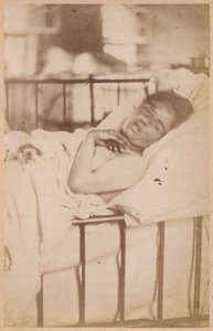 Epilepsia histérica, contracción permanente, lámina XXVIII de 