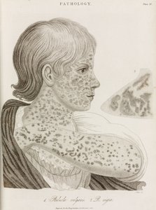 Enfermedades, Sarampión Dos tipos de sarampión de John Pardon