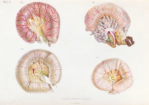 La superficie externa de los intestinos infectados con cólera, de Anatomie Pathologique du Cholera Morbus, por Nikolai Ivanovich Pirogov (1810-81) publicado en San Petersburgo, 1849 de Russian School