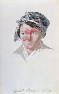 Pústulas sifilíticas agrupadas, de un libro de Baron Jean Louis Alibert, 1838 de Salvadore Tresca