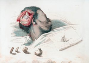 Vista de herida en el cráneo después de trepanación y extracción de fragmento de hueso roto en la parte inferior izquierda, 1821