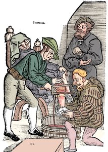 Amputación de una pierna sin anestesia, 1593
