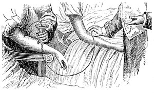Transfusión de sangre, c1880