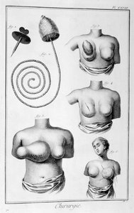 Cirugía de mama, 1751-1777 de Unbekannt