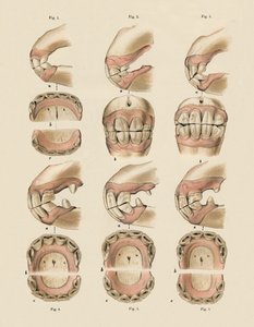 Descripción de la placa que muestra la edad, según lo indicado por los dientes, c1879