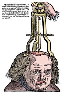 Trepanación, 1593