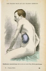 Bazo típico agrandado de un paciente con malaria, c1890