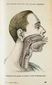 Uso de un laringoscopio para ayudar a la extracción de un pólipo de la garganta, c. 1890 de Unbekannt
