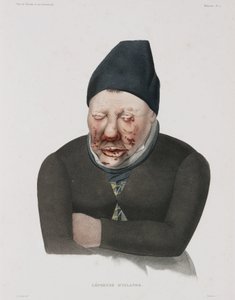 Enfermedades, lepra