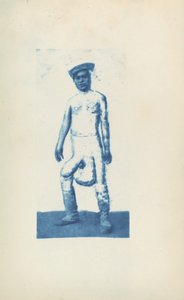 Elefantiasis