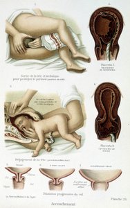 Parto - lámina científica, finales del siglo XIX de Unknown artist