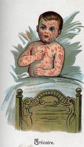 Enfermedades infantiles: Urticaria. En “La nueva medicina natural” de F.E. Bilz de Unknown artist
