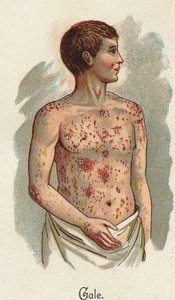 Enfermedades infantiles: La sarna. En “La nueva medicación natural” por F.E. Bilz. de Unknown artist