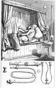 Clystère (para enemas) por Johannes Sculptetus 