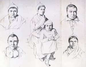 Consideraciones sobre las causas del cretinismo endémico por Morel. de Unknown artist