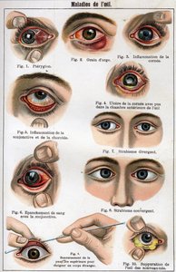 Enfermedades del ojo. “La nueva medicina natural” por F.E. Bilz. de Unknown artist