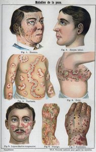 Enfermedades de la piel: Eczema, herpes labial, psoriasis, herpes zóster, lupus, prurigo, eritema. En “La nueva medicación natural” por F.E. Bilz de Unknown artist
