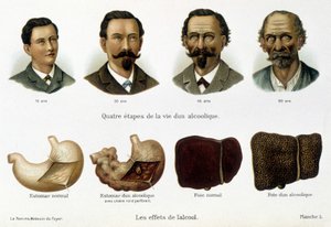 Los efectos del alcohol: las cuatro etapas de la vida de un alcohólico representadas por su rostro y su hígado - en "La mujer, médico del hogar" de Unknown artist