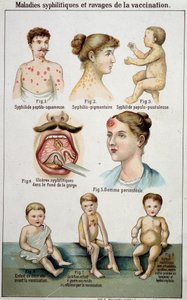 Placa que ilustra las diferentes formas de enfermedades sifilíticas y los peligros de la vacunación - en la medicina natural de Bilz, finales del siglo XIX de Unknown artist