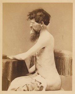 Soldado John Bar, Recuperación tras una herida penetrante en el abdomen con fractura del os innominatum izquierdo, del Catálogo Fotográfico de la Sección Quirúrgica.