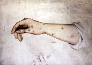 Estudio de un antebrazo con condición de la piel, c.1850 de William Lover