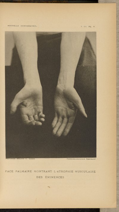 Superficie palmar con atrofia muscular de las eminencias de Albert Londe
