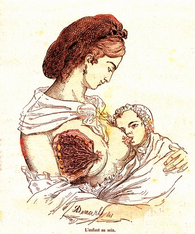 El niño en el pecho (J. Rengade