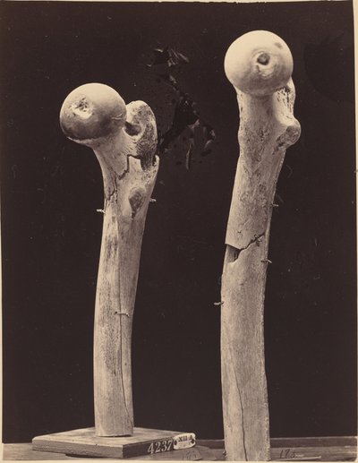 Especímenes de fracturas de fémur por disparo de American 19th Century