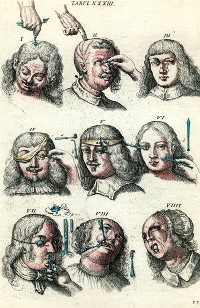 Cirugía en el siglo XVIII: Trepanación y operación del ojo y la cara. Grabado en 