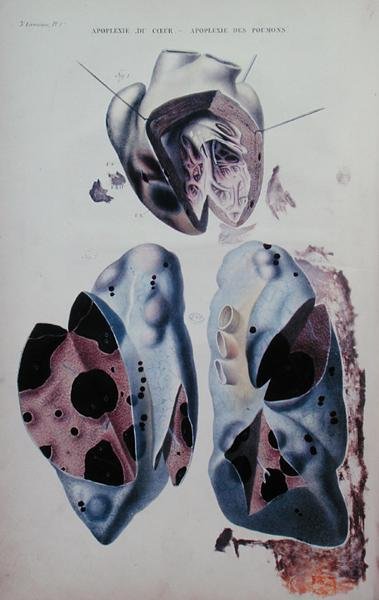 Apoplejía del corazón y de los pulmones, placa de ilustración de 