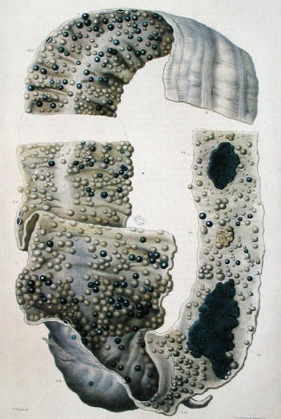 Enfermedades de los intestinos, de 