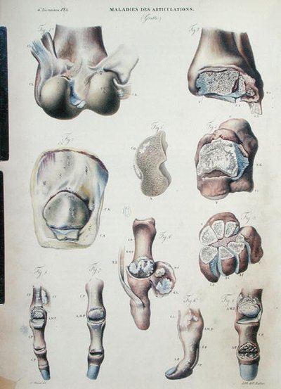 Enfermedades de las articulaciones, de 