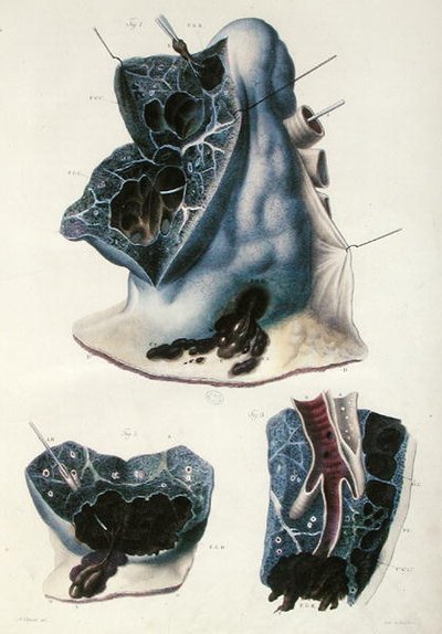 Enfermedades de los pulmones, de 