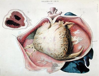 Pericarditis, placa que representa enfermedades del corazón de 