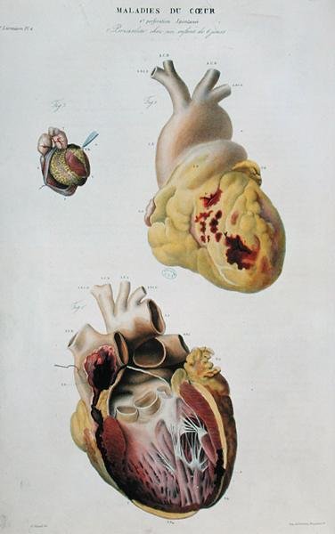 Placa que representa enfermedades del corazón. Ruptura espontánea del corazón de una mujer de 86 años (fig. 1) y pericarditis en un bebé de seis días (fig. 2), de 