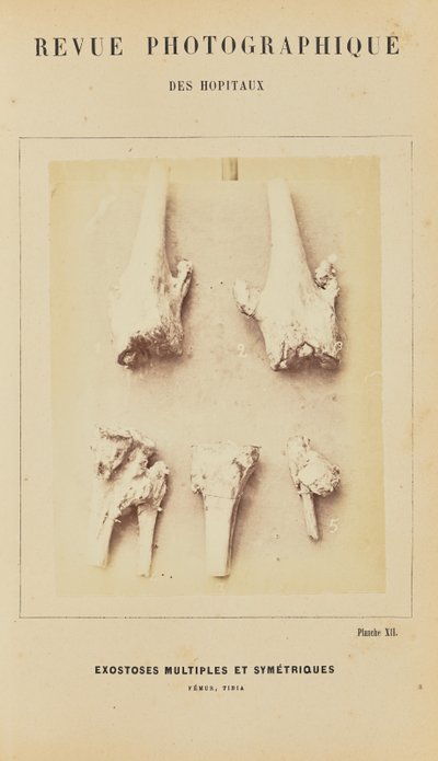 Múltiples exostosis simétricas, fémur, tibia de Arthur de Montmeja