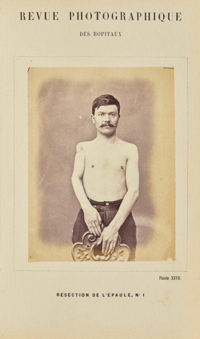 Resección de hombro, número 1 de Arthur de Montmeja