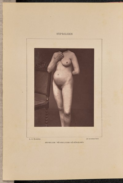 Sífilis vesicular generalizada de Arthur de Montmeja