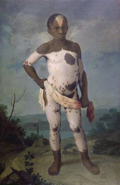 Niño con vitiligo, 1786 de Brazilian School