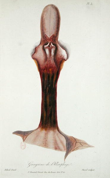 Gangrena del esófago, de 