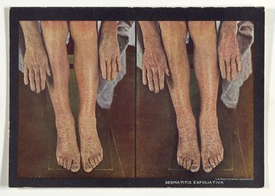 Dermatitis exfoliativa de Dr. Selden I. Rainforth