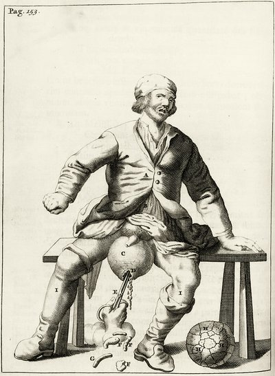 Drenando líquido de un hidrocele del escroto, de Exercitationes Practicae circa Medendi Methodum por Frederik Dekkers, 1694 de Dutch School