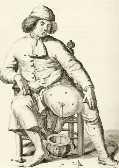 Drenando líquido de un absceso, de Exercitationes Practicae circa Medendi Methodum por Frederik Dekkers, 1694 de Dutch School